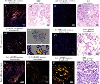 Monitoring of breast cancer progression via aptamer-based detection of circulating tumor cells in clinical blood samples